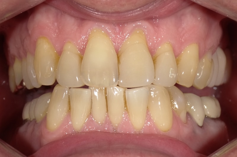 Verfärbte Zähne und freiliegende Zahnhälse
